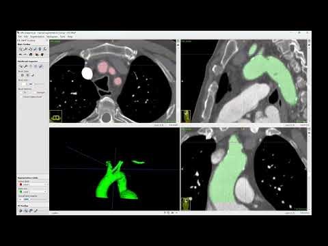 Semi-Automatic Segmentation using ITK-SNAP - Tutorial