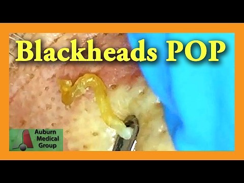 Blackheads POP! | Auburn Medical Group