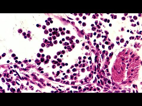 What is Acute Inflammation? - Pathology mini tutorial