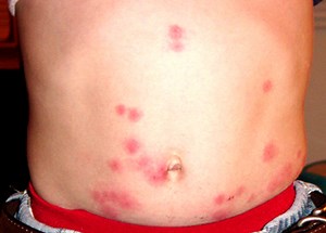 Bed Bug Symptoms: Pictures, When They Appear and Treatment