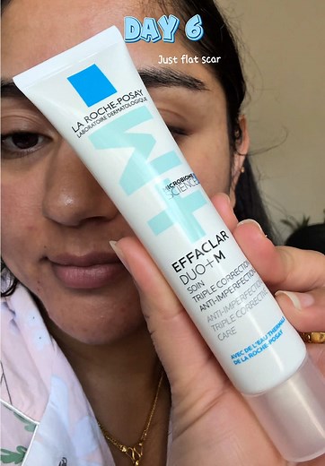 Effective Treatment for Deep Cystic Acne with Effaclar Duo
