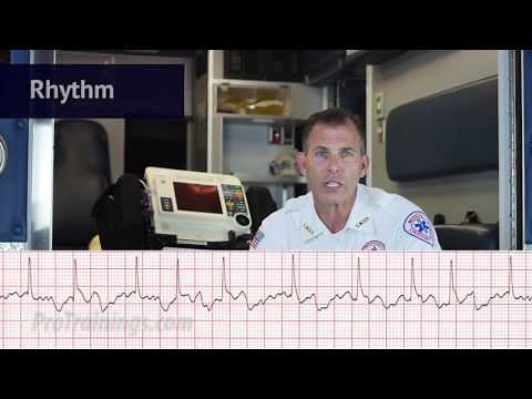 Atrial Fibrillation (ECG Rhythm Interpretation)