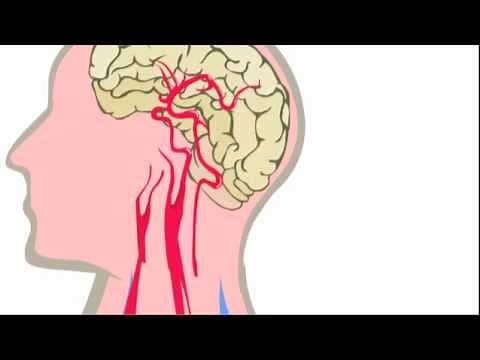 Coilen: behandeling van een aneurysma in de hersenen