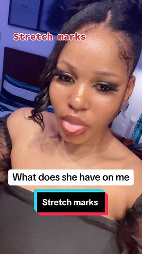 #stretchmarks #stretchmarkremoval skincare #skincareroutine #skincaretips #skincare101 #explore