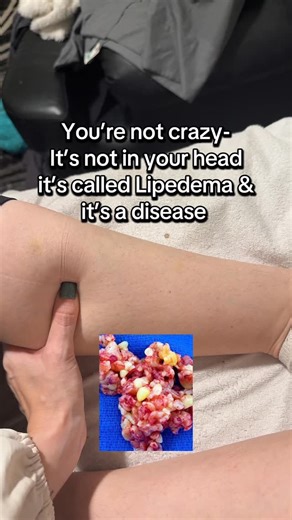 Michelle Keith on Instagram: "If this list made you pause… trust that. Bruising easily, painful fat, pebble-like nodules, swelling, heaviness after light activity, boots not fitting — these are not normal weight-loss struggles. For many women, this is lipedema — a connective tissue disease that’s often dismissed as “just fat” or “inflammation.” You’re not lazy. You’re not broken. And it’s not in your head. There are ways to reduce pain, swelling, and progression once you understand what’s actual