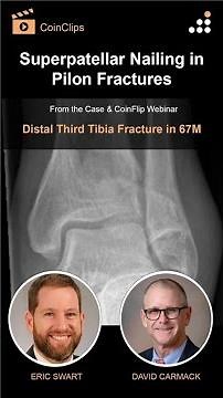 Superpatellar Nailing in Pilon Fractures