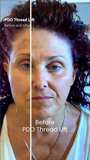 PDO Thread Lift Before and After. Non-surgical Facelift, PCH MedSpa, Newport Beach