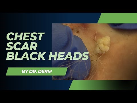 Chest Scar Blackheads | Dr. Derm