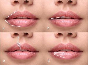 Lip Filler Techniques: All You Need To Know