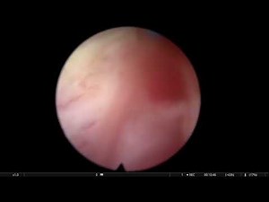 Real Life HoLEP Cases - 9 Consecutive HoLEPs recorded in Sofia, Bulgaria