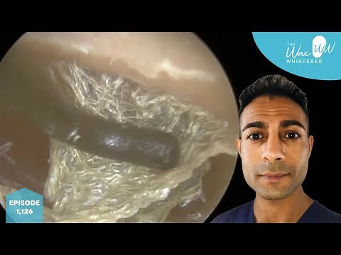 1,126 - Dead Skin Peel & Stripping from Ear
