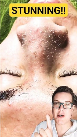 ULTIMATE PORE STRIP REMOVAL - How To Prep Skin For Pore Strips #shorts