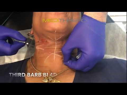 PDO-THREAD LIFT TUTORIAL BY MEDiTHREAD - Neck Lift