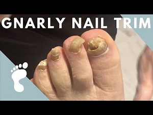 How to Trim Thick Toenails with Fungus