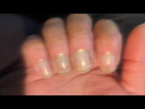 Cancer, do these dark lines in my fingernails mean that?