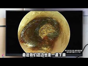 Deep Ear Cleaning Procedure — Insanely Satisfying Ear Wax Removal