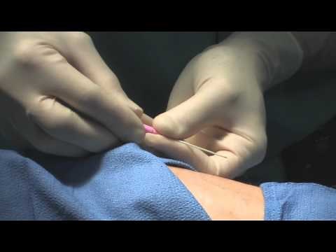 Arterial Line Insertion