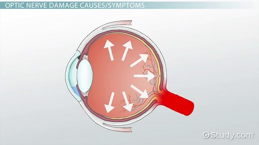 Optic Nerve Damage | Overview, Symptoms & Treatment