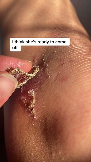 Part 2 Scab update #scab #scabremoval #wound #heal | scab