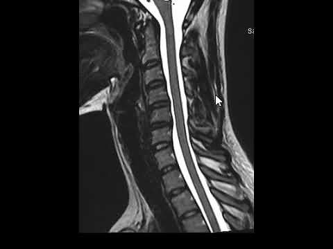 How to read and MRI of the cervical spine | First Look MRI