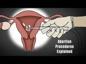 How Abortion Works in Each Trimester — Complete Medical Guide