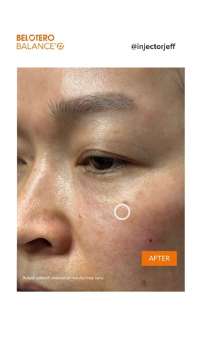 Belotero Balance (+) on Instagram: "Say goodbye to puffy under-eyes! Check out these smooth, natural-looking results from an under-eye treatment with Belotero Balance® (+). We’re sending a big shout out to @injectorjeff for sharing! Patient received 1 syringe total of Belotero Balance (+) in the infraorbital hollows. Photos were taken before and immediately after treatment. Individual results may vary. BELOTERO BALANCE® (+) IMPORTANT SAFETY INFORMATION BELOTERO BALANCE® (+) is FDA-approved to sm