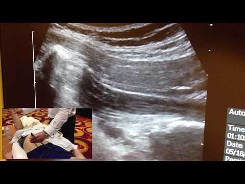 Ultrasound Guided Piriformis Injection