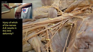 2.3K views · 47 reactions | In this dissection of the axilla, identify the nerve responsible for the limb deformity shown in the picture. Confirm your answer and learn more by watching the full video: Picture Tests in #Anatomy arm and forearm 1 on Human Anatomy Education YouTube Channel @ https://www.youtube.com/watch?v=4zIRavpIB0o | Human Anatomy Education | Facebook