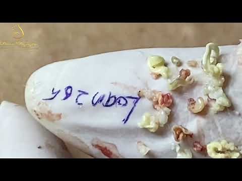 Loan Nguyen Acne Treatment 1526h