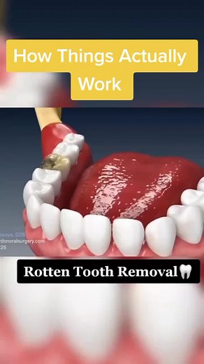 Rotten Tooth Extraction: How Things Actually Work