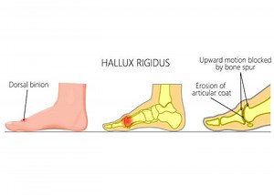 Hallux Rigidus | Stiff Big Toe | Greater Toe Arthritis | Vail, Frisco, Denver CO