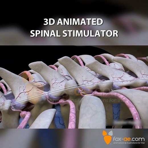 Spinal Cord Stimulator