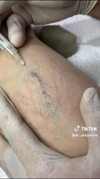 Understanding Varicose Veins Treatment Options