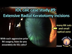 CataractCoach 1644: IOL calc case study 9: extensive radial keratotomy RK