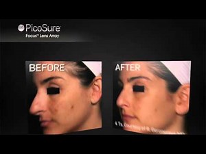 PicoSure Laser MOA