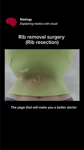 🩻 Rib Removal Surgery