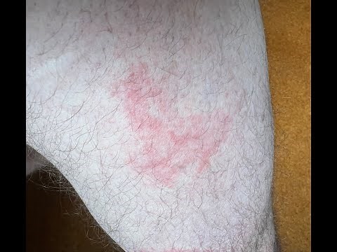Bed Bug Rash - Everything You Need To Know About a Bed Bug Rash