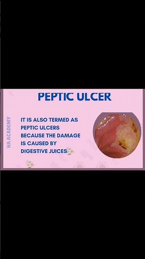 ALL TYPES OF ULCER WITH CAUSES ,SYMPTOMS AND TREATMENT. #hacademy #ulcers #digestivedisease