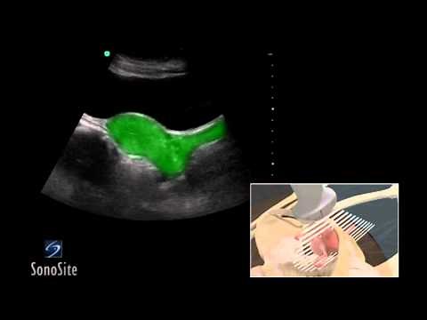 How To: Female Pelvis Ultrasound Exam 3D Video