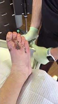 External Pin Removal