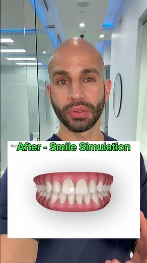 Invisalign Before and After Smile Simulation: How it Works