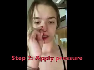 BleedStop™ Nosebleed Strips Stop Mild to Severe Nosebleeds.