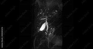 Magnetic resonance cholangiopancreatography or MRCP 3D MIP view showing visualize the biliary and pancreatic ducts .