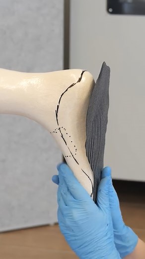 Working with prepreg – ready for the next step? The advanced video seminar on prepreg processing builds on the basic seminar. New skills: 💪🏼 Using profiling materials correctly 💪🏼 Incorporating additional components Book now – watch for 1 month – create particularly light and strong fibre composites! #streifeneder #orthoproductionacademy #furthertraining #videoseminar #orthopaedics ➖➖➖➖➖➖ Arbeiten mit Prepreg – bereit für die Fortsetzung? Das Aufbau-Videoseminar Prepreg-Verarbeitung baut auf