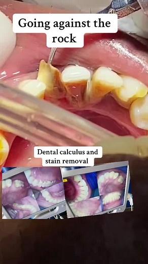Teeth Cleaning and Dental Calculus Removal Techniques
