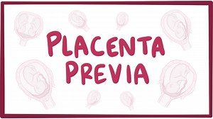 Placenta previa: Video, Causes, & Meaning | Osmosis