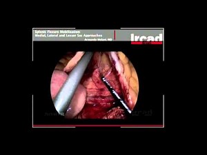 Splenic Flexure Mobilization from the SAGES Video Library