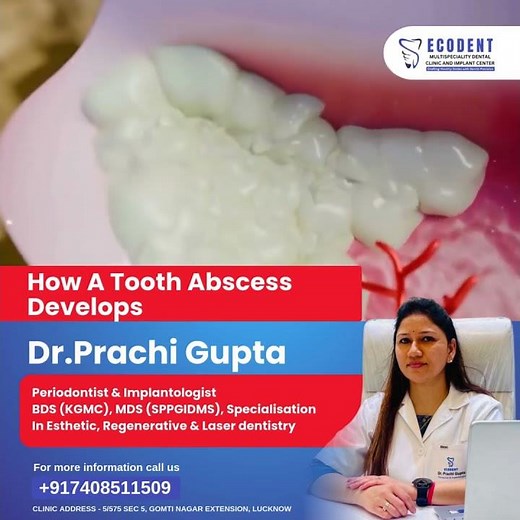 How a Tooth Abscess Develops | Symptoms & Treatment Explained 🦷💢