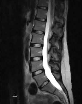Lumbar spine disc herniations
