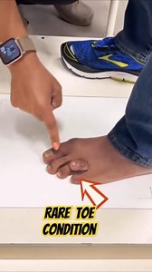 Extreme Toe Deformity Explained by Surgeon – Rare Case or Procedure?